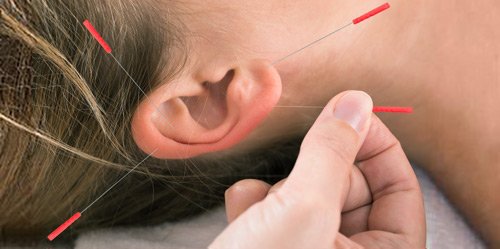 Рефлексотерапия Рефлексотерапия