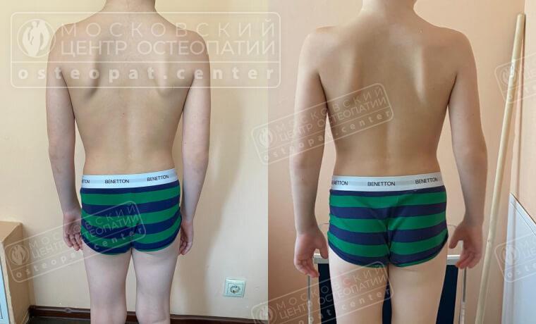 После лечения остеопата выровнялась спина