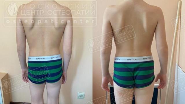 После лечения остеопата выровнялась спина