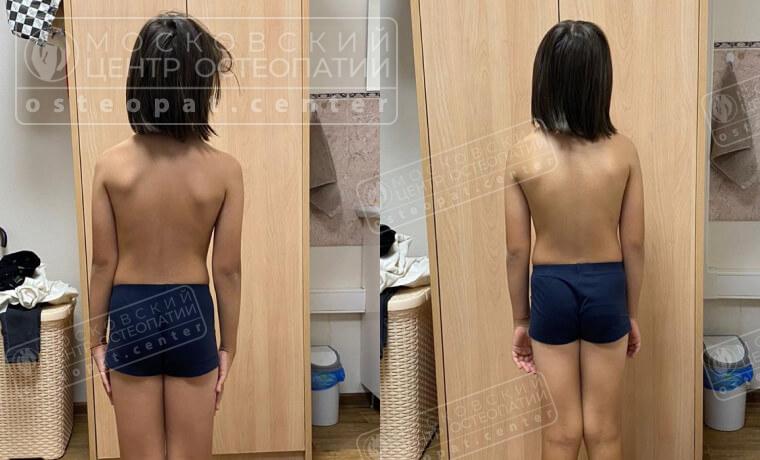 После 1 сеанса визуально Миша выпрямился