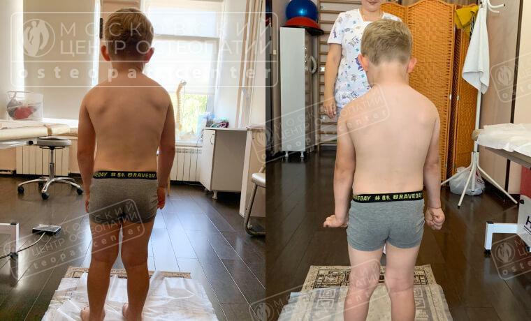 Правое плечико выпрямилось после 3 сеанса