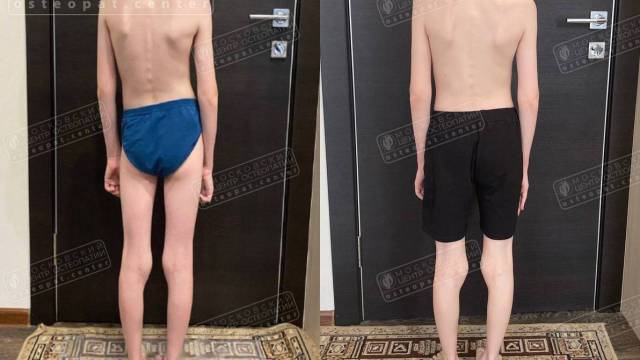 Сколиотическая осанка, косой таз, проблемы с дыханием